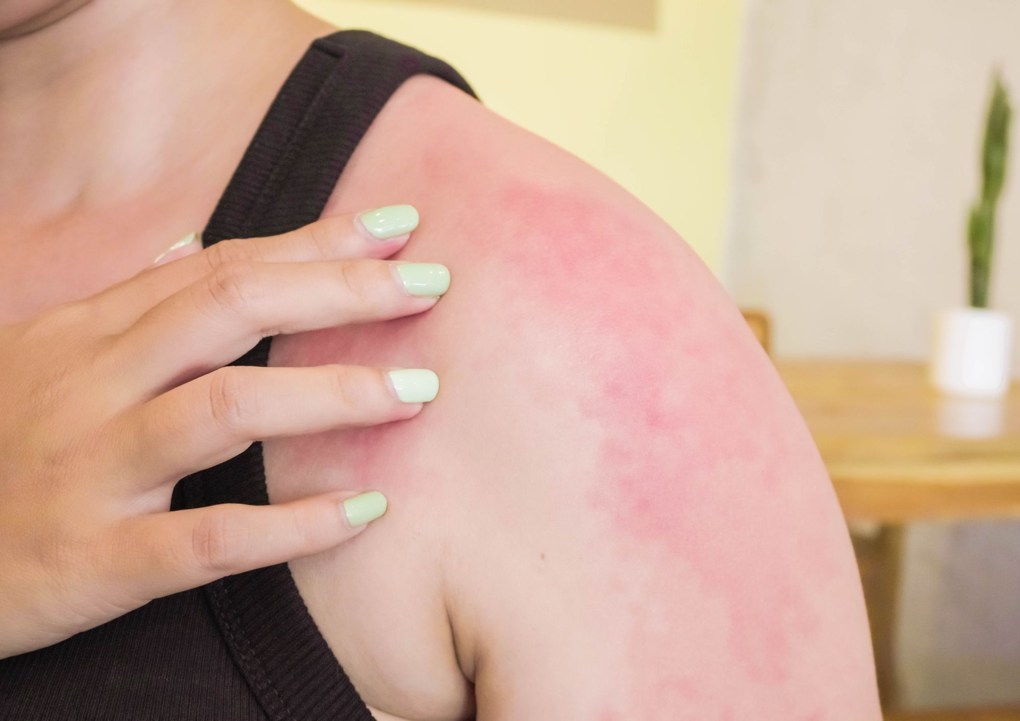 איך לטפל בכוויה מהשמש