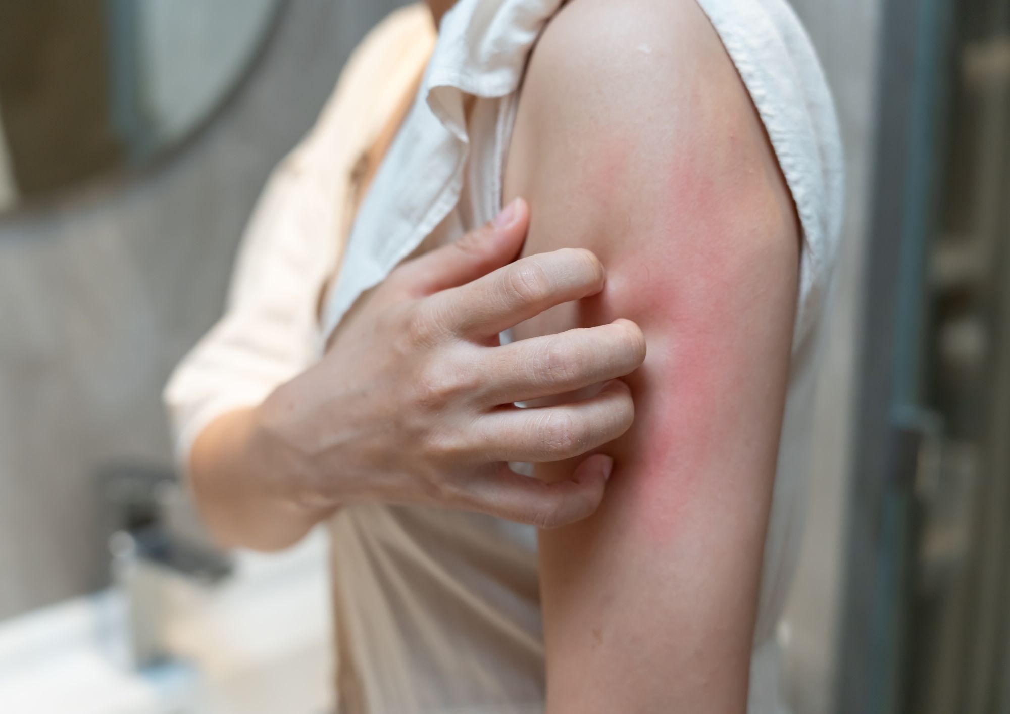 איך לטפל בכוויה מהשמש