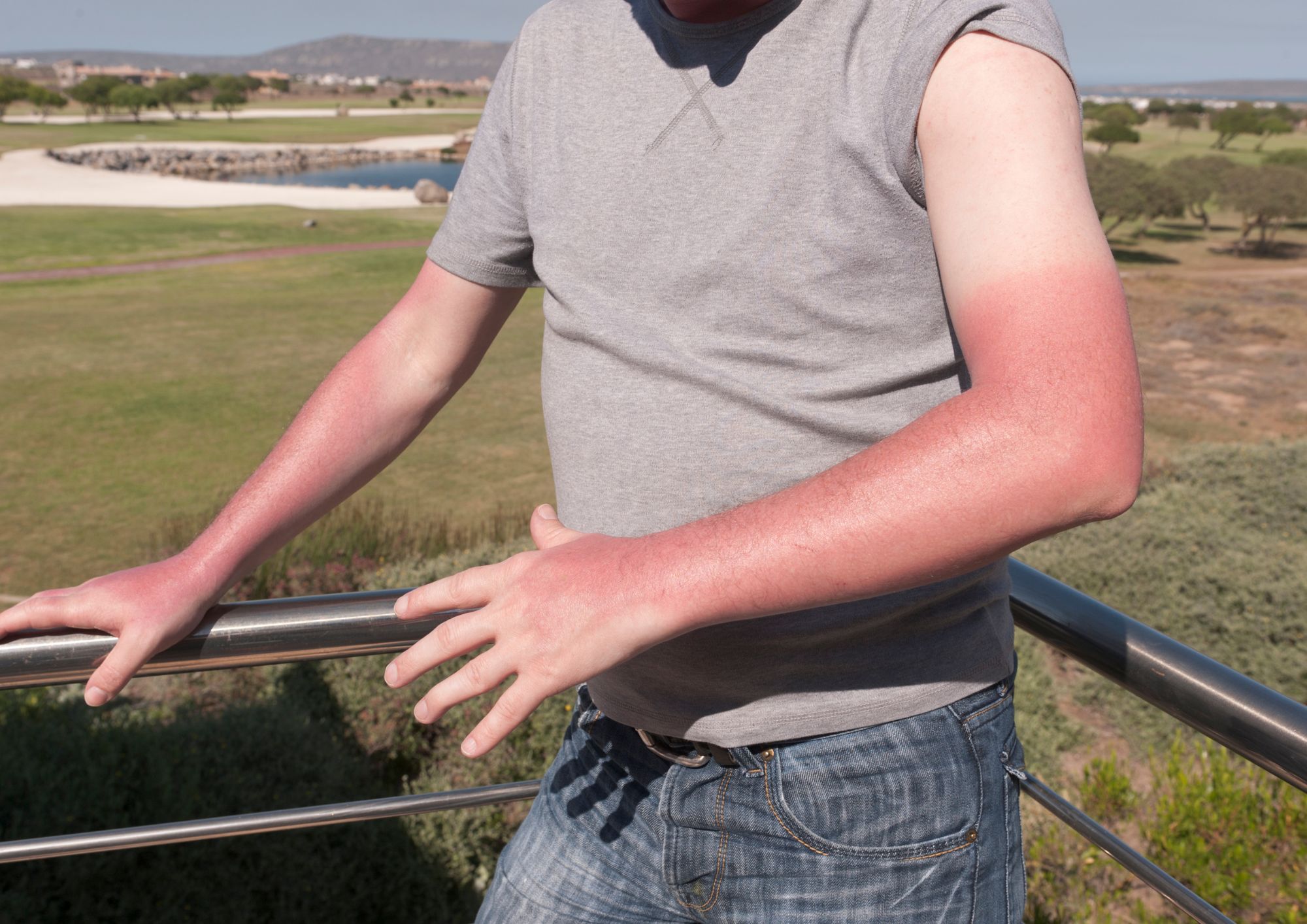 איך לטפל בכוויה מהשמש