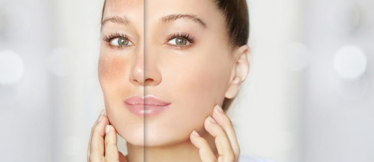 מלזמה: טיפול טבעי אפקטיבי להעלמת הכתמים