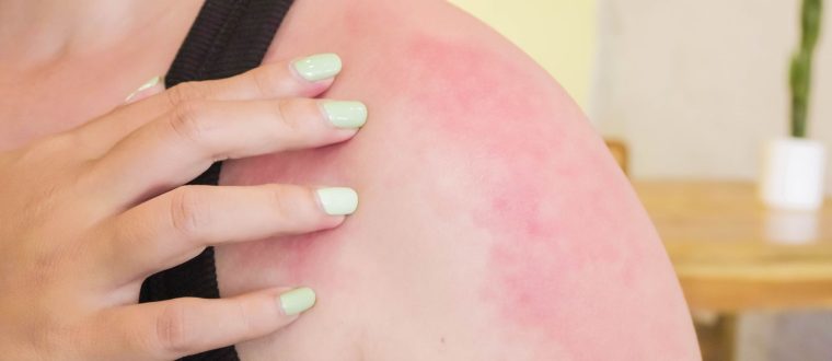 איך לטפל בכוויה מהשמש – כל מה שחשוב לדעת לריפוי מהיר של העור